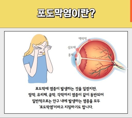 포도막염