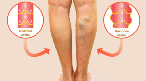 하지정맥류운동