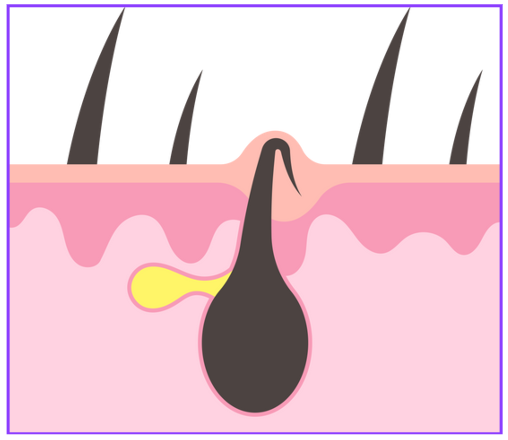 모낭염 원인과 치료방법