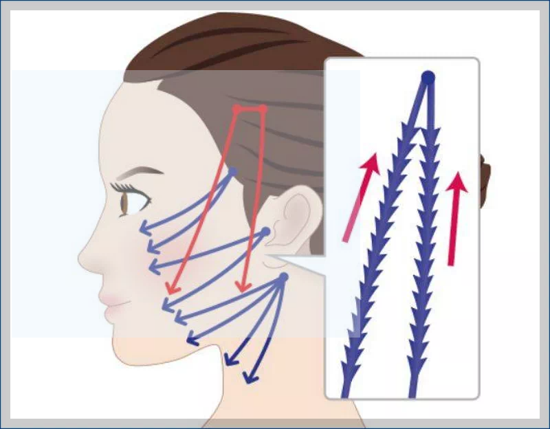 실리프팅 핵심기술