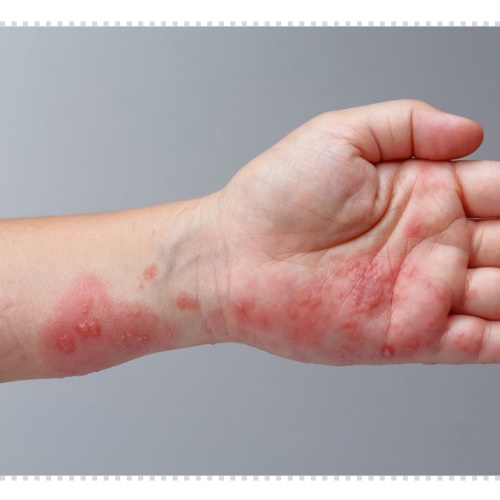 귀 대상포진 증상 후유증