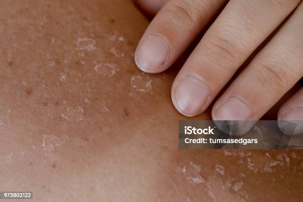 박탈성 피부염 관련 사진