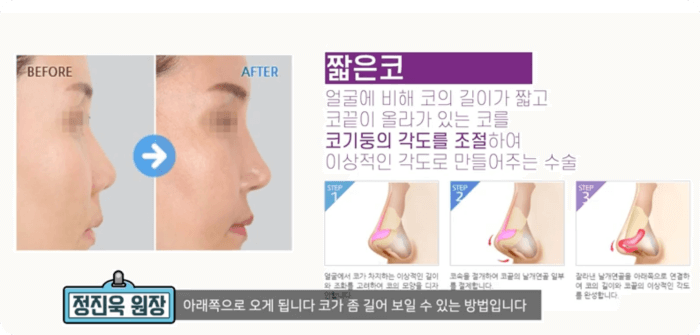 짧은코 성형수술 - 정진욱 원장
