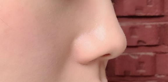 코조각주사 후기