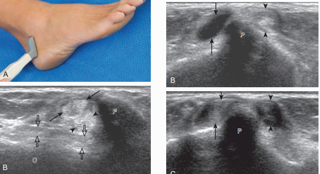 가쪽 발목 검사(lateral ankle evaluation)