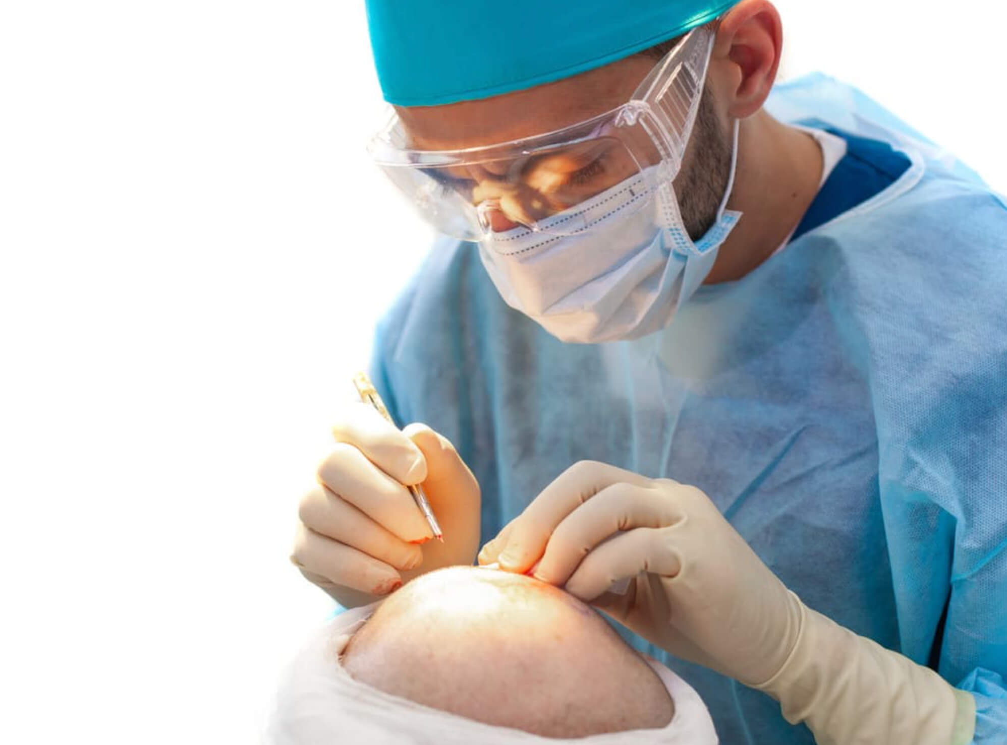 모발이식 부작용