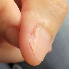 손톱이 잘 자라지 않는 이유