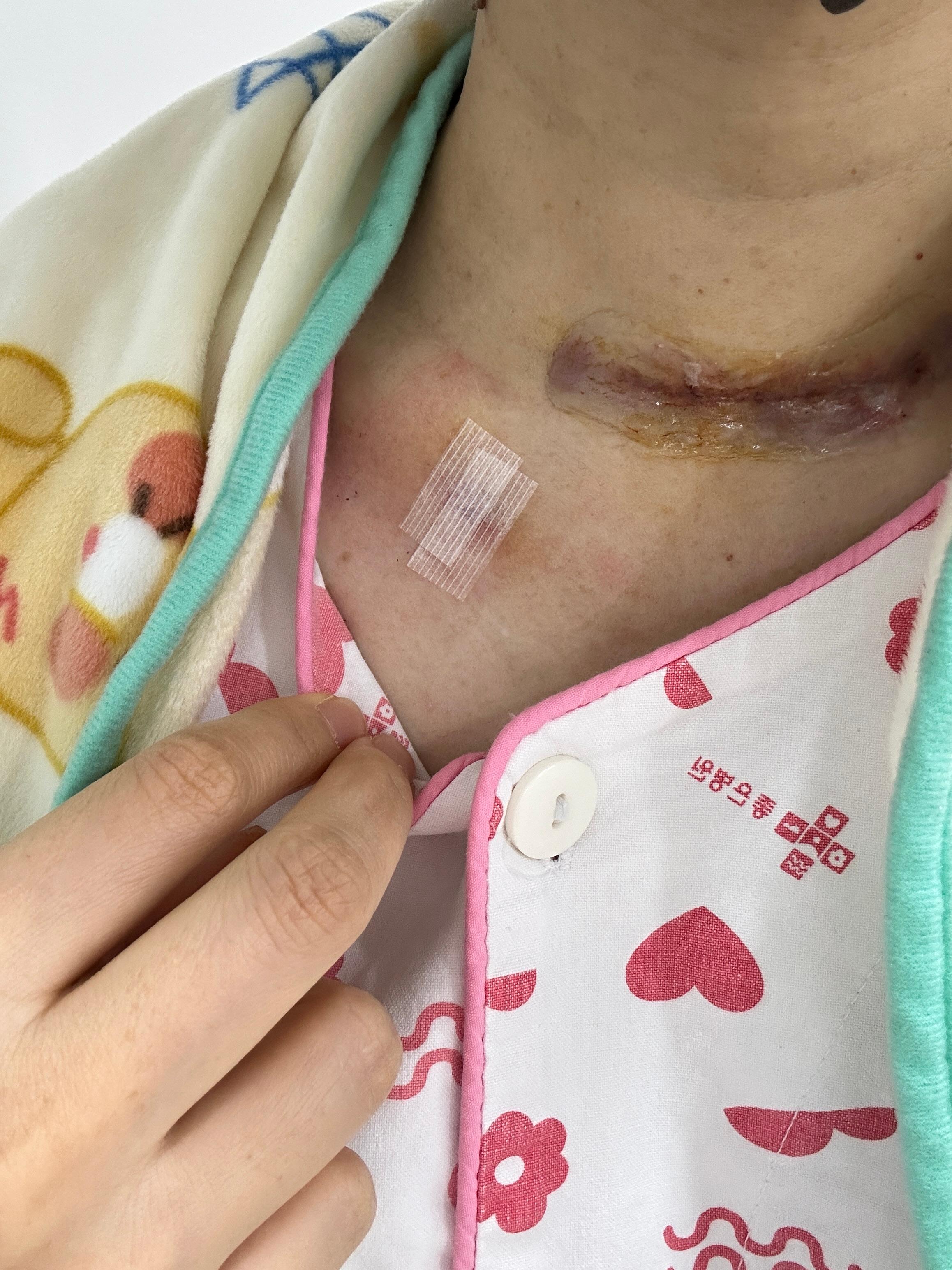 갑상선암 수술 후 배액관 제거