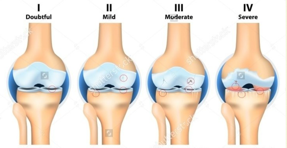 무릎 퇴행성 관절염의 진행 단계