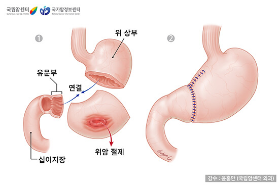 유문보존수술 (출처 : 국립암정보센터)