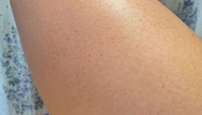 자반증 초기증상