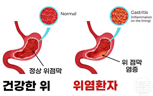 위염에 좋은 음식 위염에좋은차 위염음식