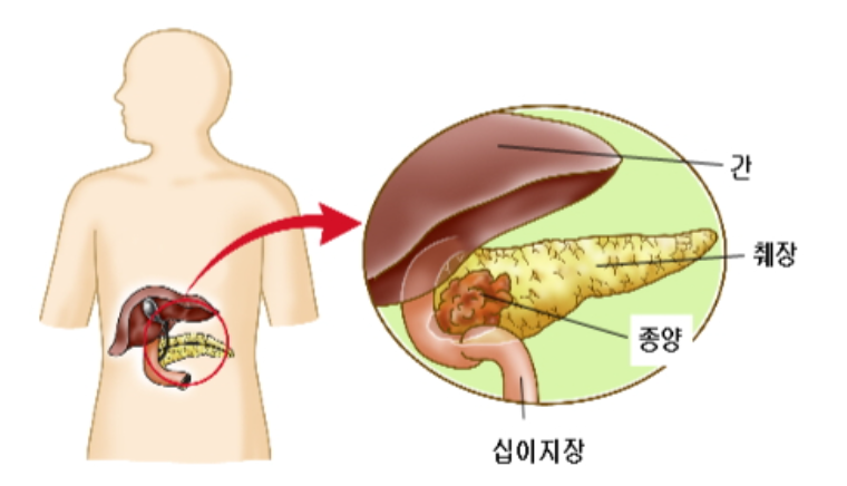 췌장암초기증상