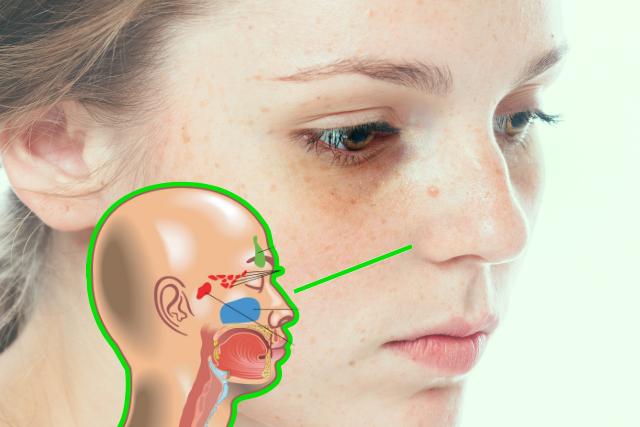 눈밑 지방 다크서클 원인 부비동염 알레르기