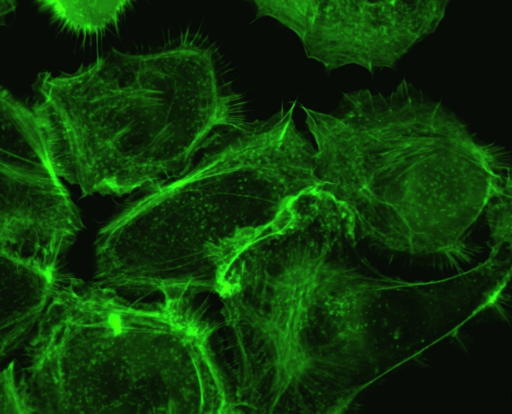 췌장암 초기증상 관리법 총정리