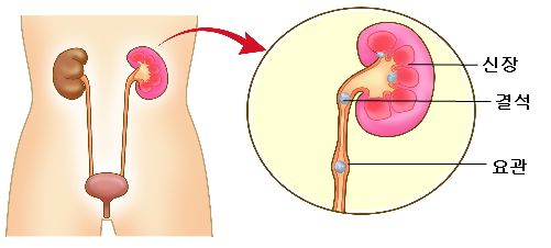 요로결석