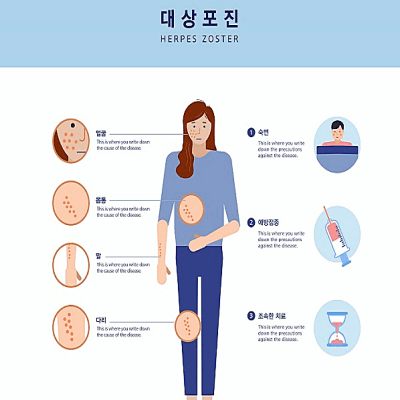대상포진 초기증상