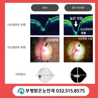 녹내장 진단 검사 비용 안압 검사주기 관리법_12