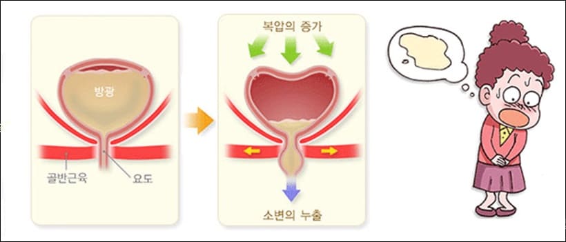 복압성 요실금 원인