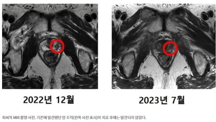 국내 첫 중입자 치료 '전립선암 환자...'암' 완전히 사라졌다