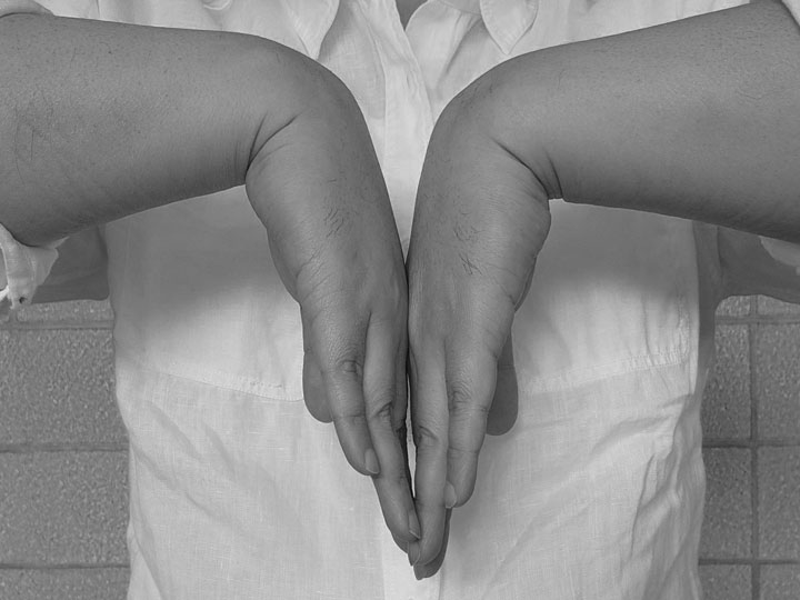 손목터널증휴군자가진단법