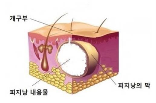 피지낭종의 단면도