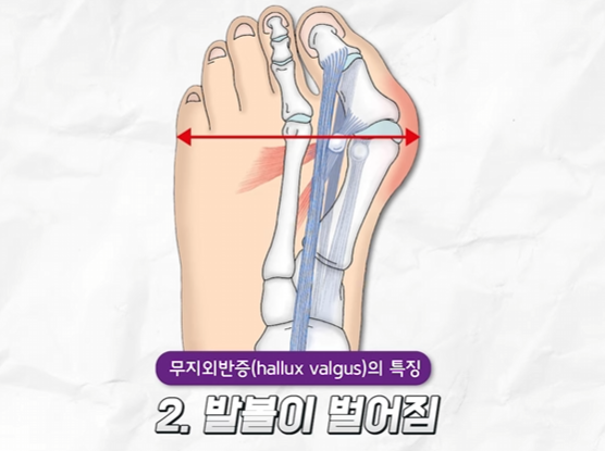 무지외반증2