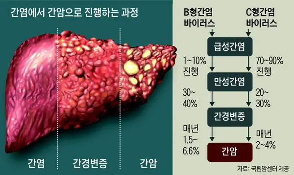 간암