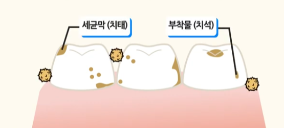 치은염의 원인 및 증상