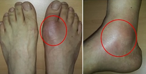 통풍환자의 발