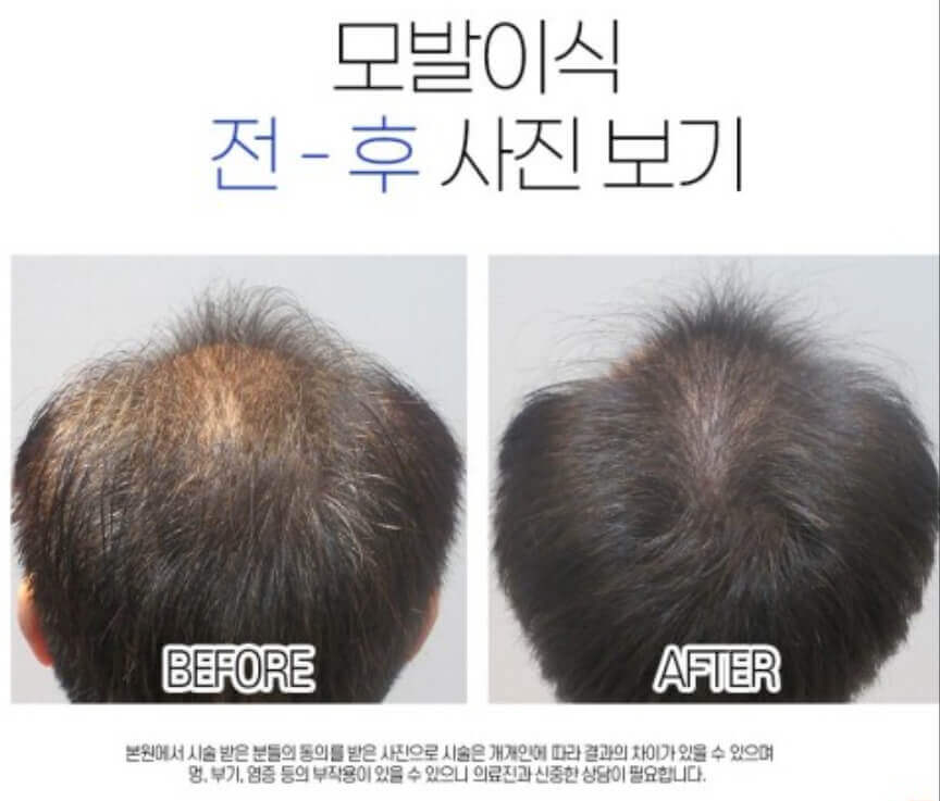 모발이식 전 과 후