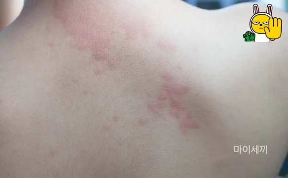 대상포진 백신
