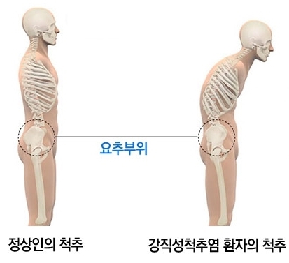 강직성척추염