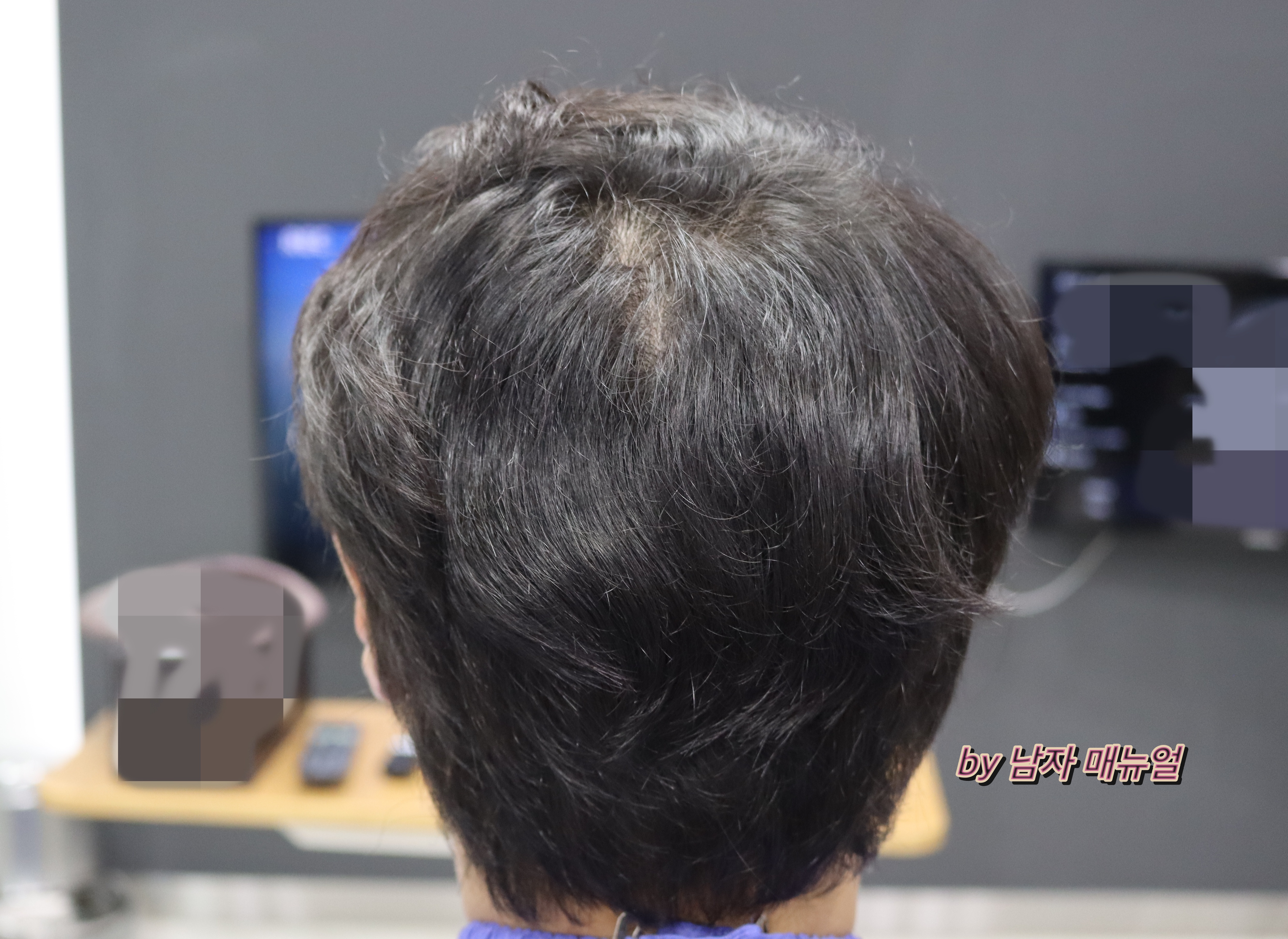 비절개-모발이식-후기