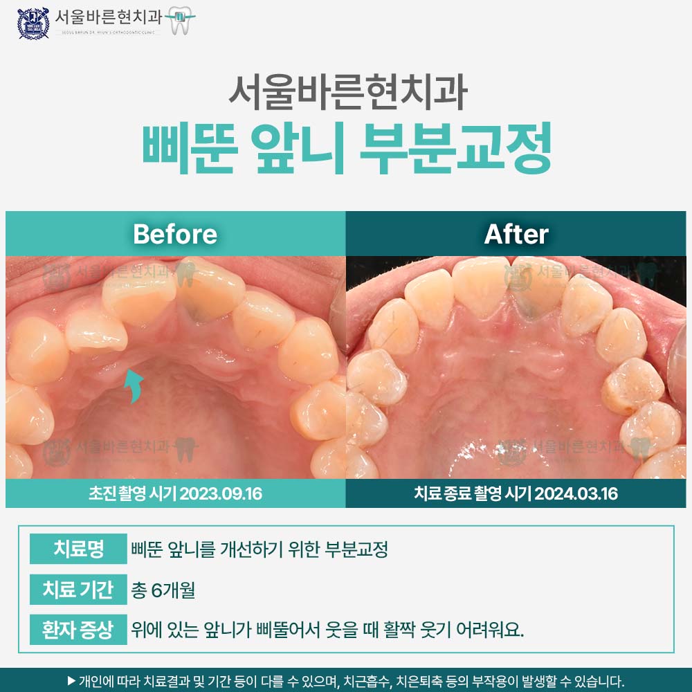 부산해운대앞니교정