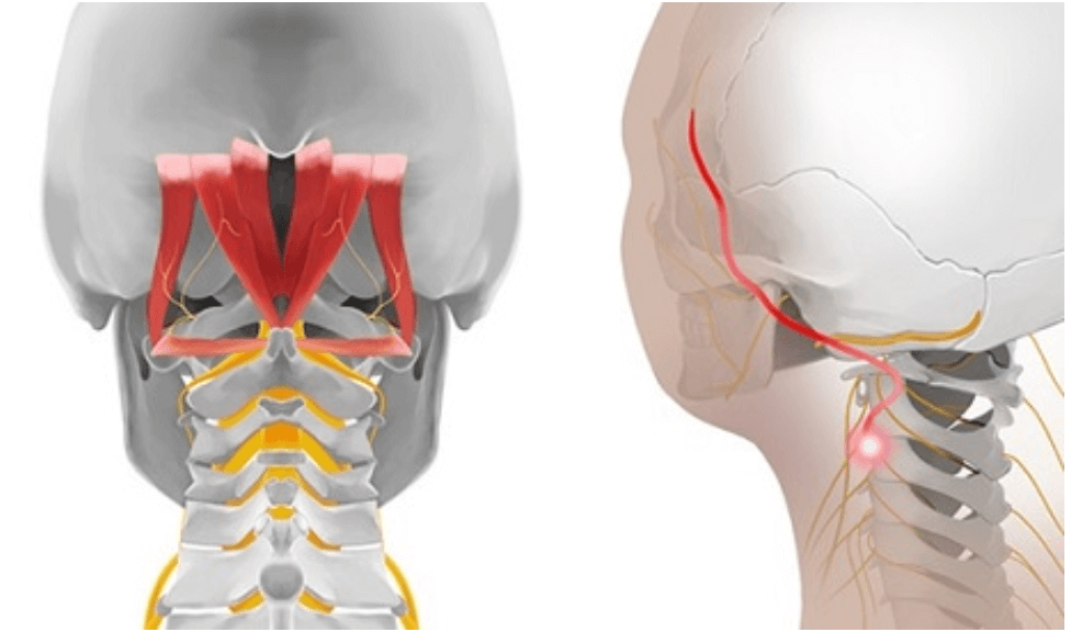 목디스크 증상 두통