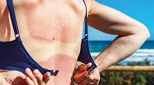 화상 물집 치료방법, 터뜨리지 말고 이렇게 치료하세요!