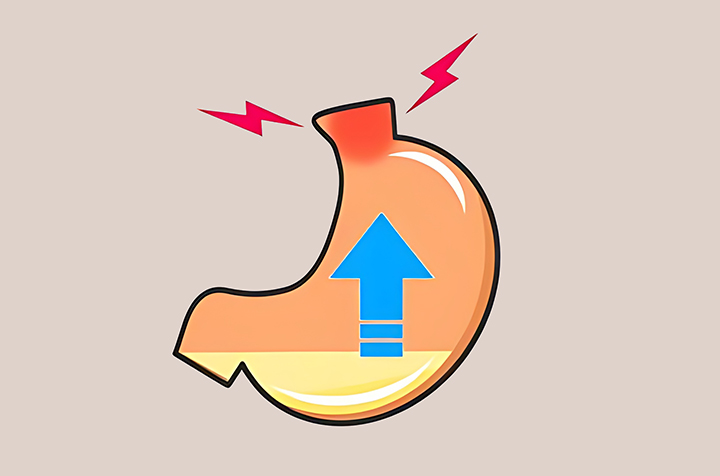역류성식도염이-있는-위-모습