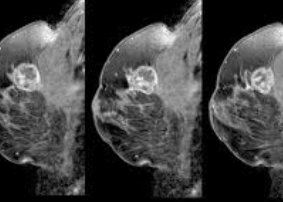 유방암에 좋은음식 2