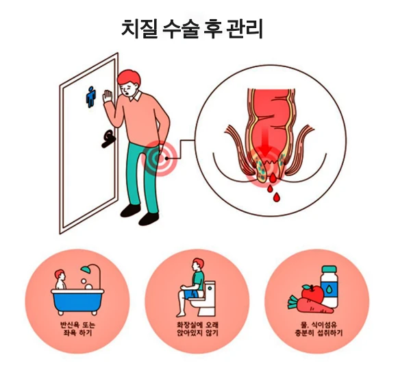 치질 수술 후 완쾌를 위한 방법들을 소개하는 이미지