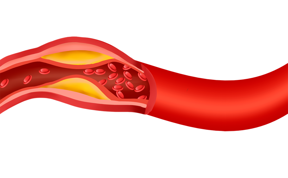 고지혈증과 혈관