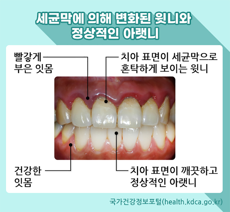 치주질환