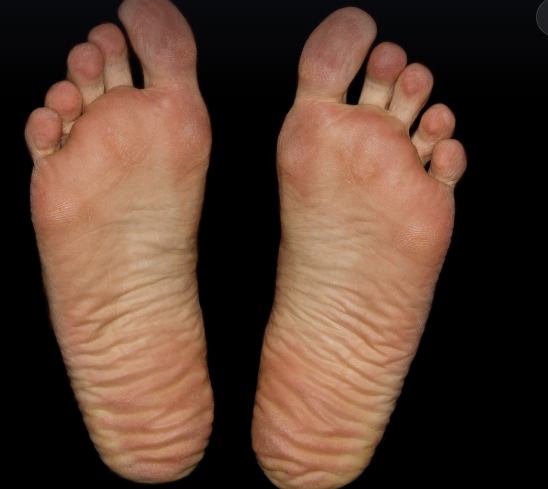 발바닥이 화끈거리는 이유