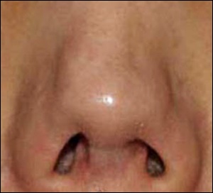 코구축현상 사진