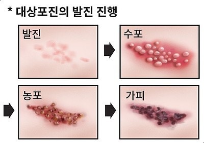 대상포진 증상과 자가 진단 방법, 치료&middot;예방 총정리 관련 사진