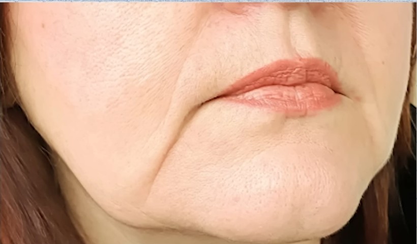 마리오네트 주름