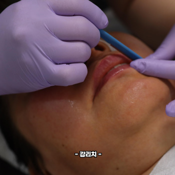 여드름 흉터 없애는 법