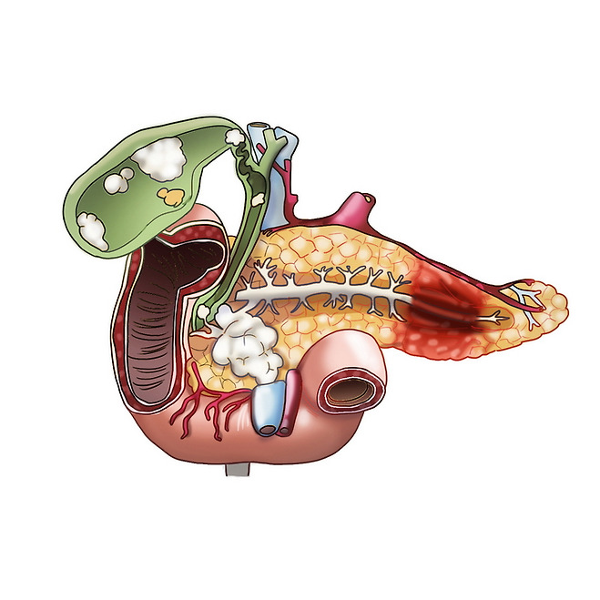 췌장암 초기증상