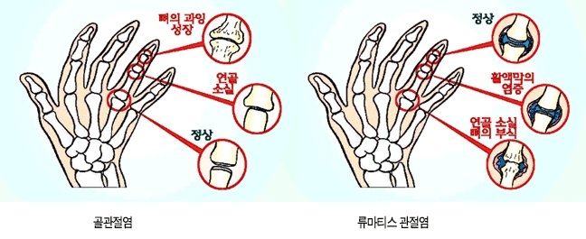 퇴행성-관절염과-류마티스-관절염