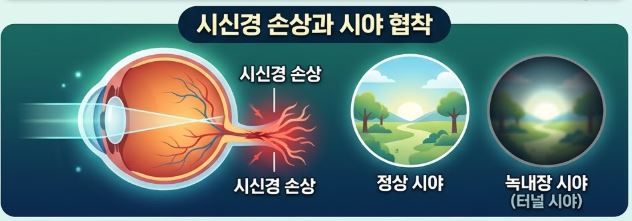녹내장의 좋은 음식